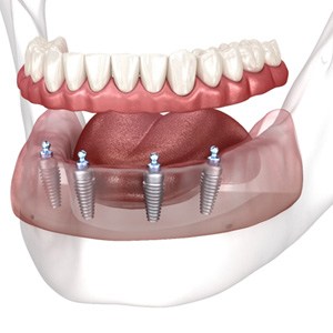 Digital model of a mouth and a lower implant denture 