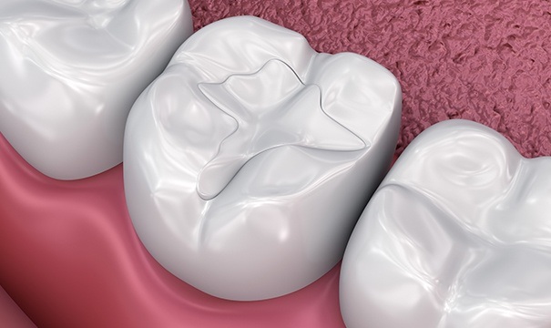 Animation of tooth-colored filling
