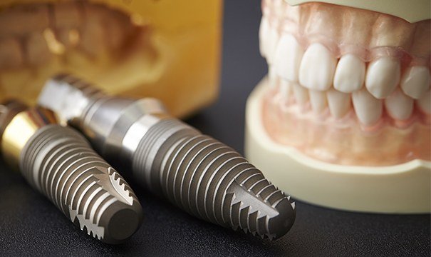 Model smile and dental implant posts