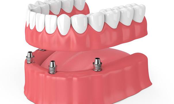 implant-retained denture on bottom arch