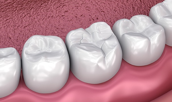 Digital model of a tooth-colored filling