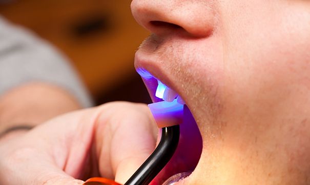 Dental light used for tooth-colored fillings
