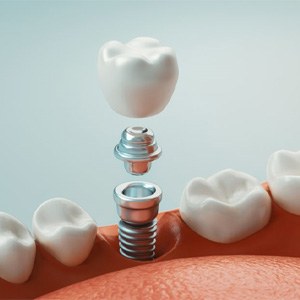 a 3 D illustration of a dental implant and abutment