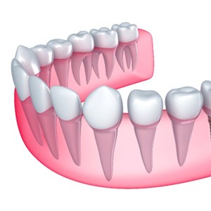 Render of a single dental implant in Newton, MA for lower arch