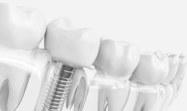 Render of a dental implant in Newton, MA in a plastic tray