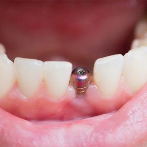 Close-up of a single dental implant in Newton, MA in the jaw