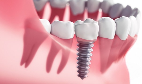 Animation of implant supported dental crown