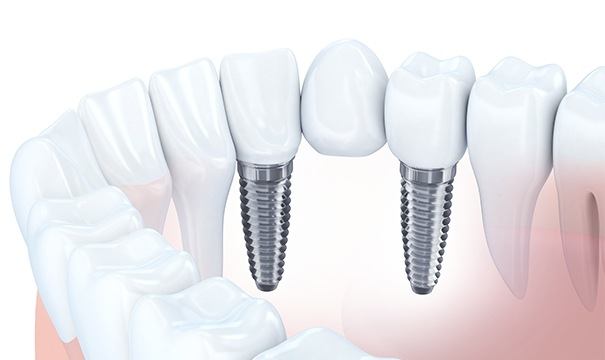 Animation of implant supported fixed bridge