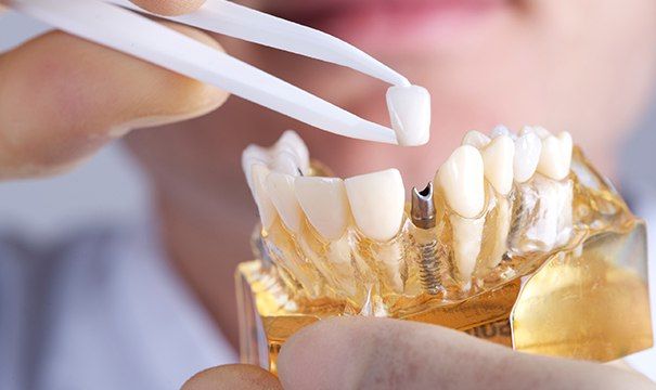 Model implant supported dental crown