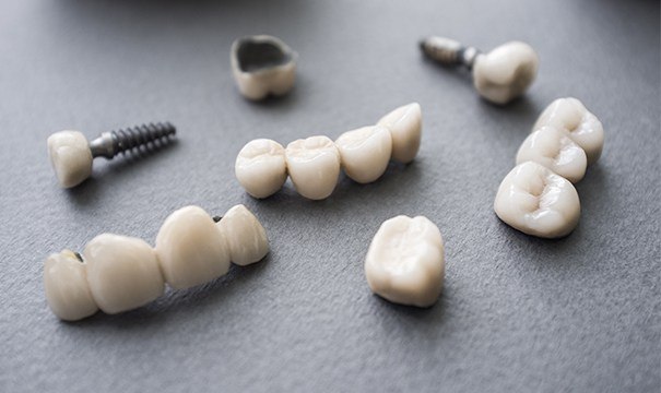 Different styles of implant supported dental restorations