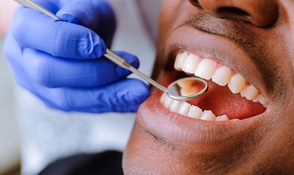 Closeup of smile after tooth-colored filling palcement