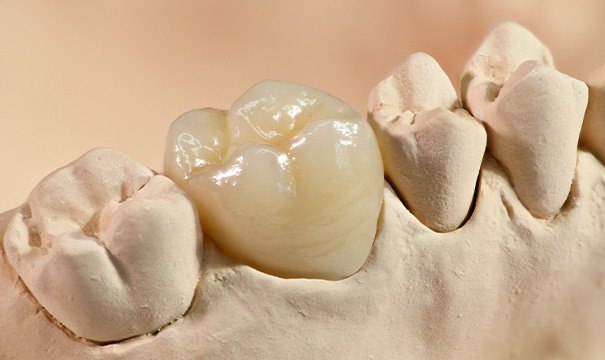 Model smile with dentla crown restoration