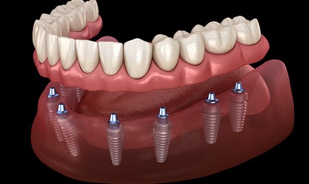 A 3D illustration of implant dentures