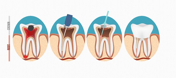 illustration for root canal therapy in Newton