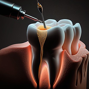 Digital illustration of a root canal