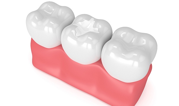 Image of a dental sealant on a molar