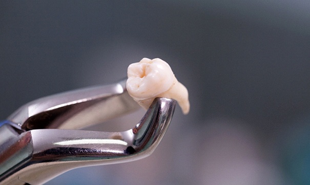 Forceps holding extracted tooth in Newton