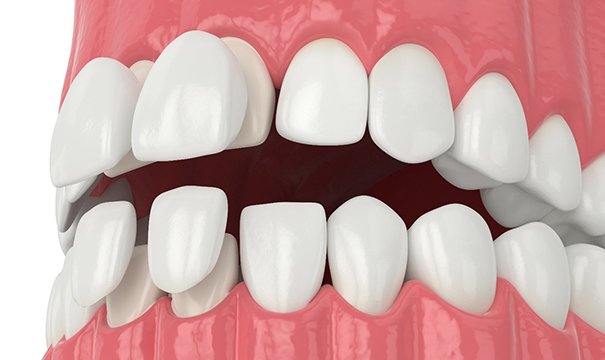 a digital graphic of teeth with porcelain veneers