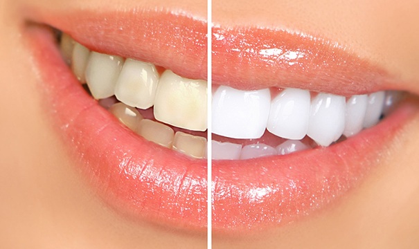 Closeup of teeth before and after visiting Newton dentist 