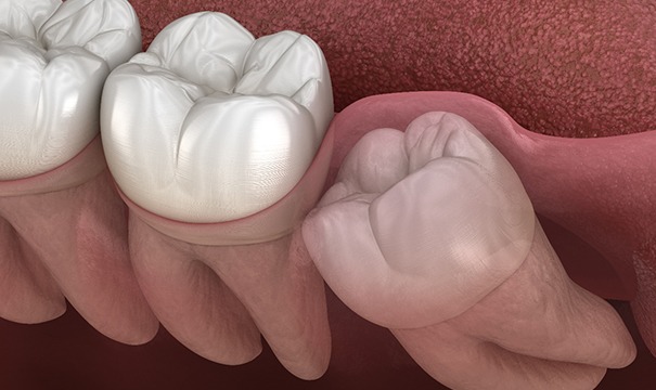 Illustration of wisdom tooth trying to emerge from beneath gums