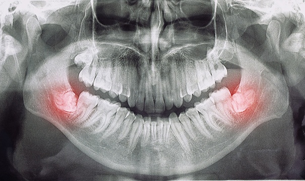 X-ray of mouth with impacted wisdom teeth highlighted
