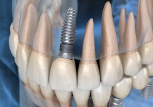 model of single dental implant at dentist office