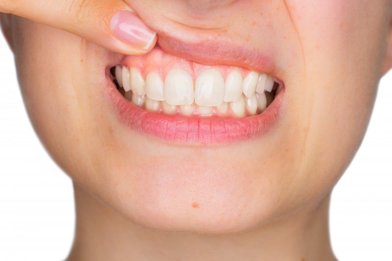 Closeup of woman pointing to her gums