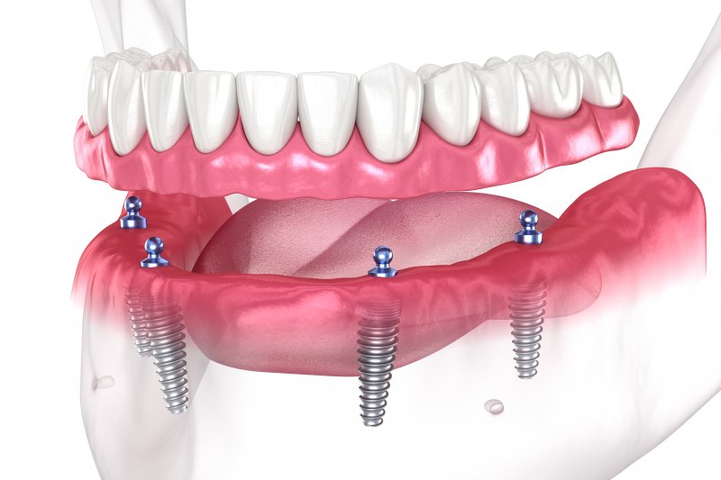 3D render of all-on-4 dental implants