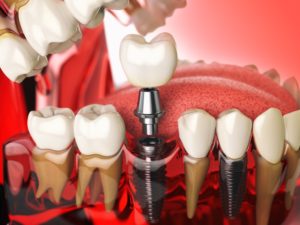 Model of single tooth dental implant