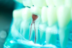 Close up of a severely damaged tooth requiring a root canal