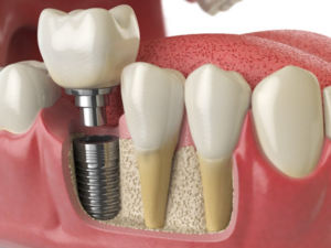 Digital image of teeth that shows each individual part of a dental implant